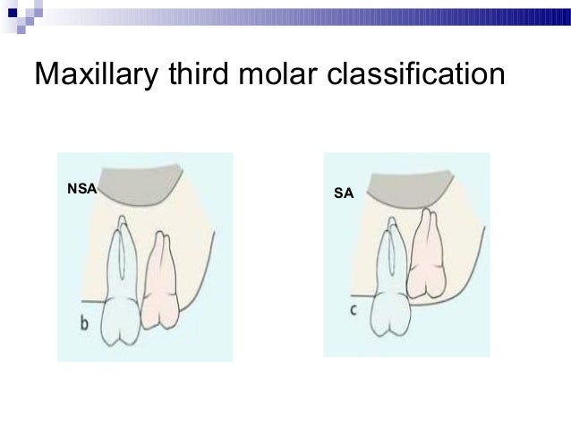third molar impaction classification pdf